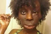 Alyssa McDonald proudly wears her scarred face